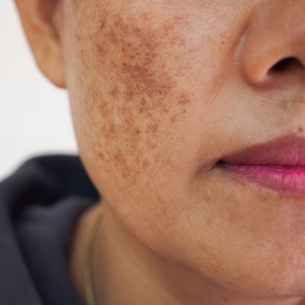 Understanding Melasma: Is it just about hormones?